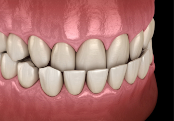 Common Problem - Underbite