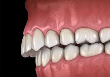 Common Problem - Upper Front Teeth Protrusion